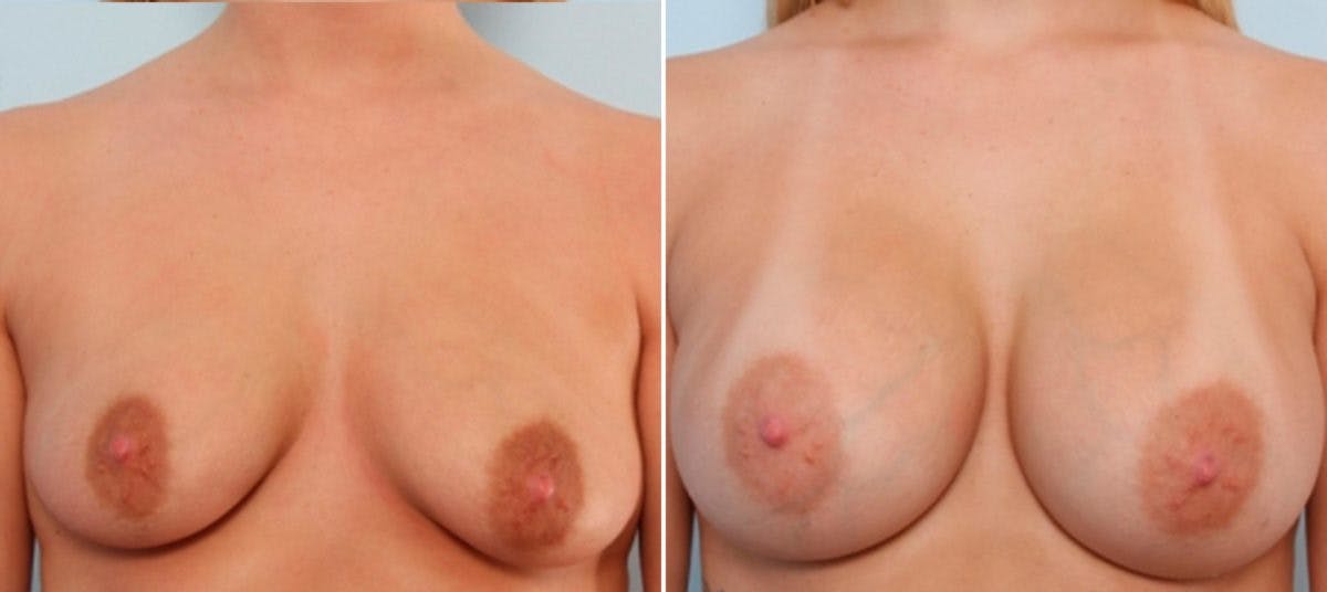 Breast Augmentation Before & After Gallery - Patient 54883907 - Image 1