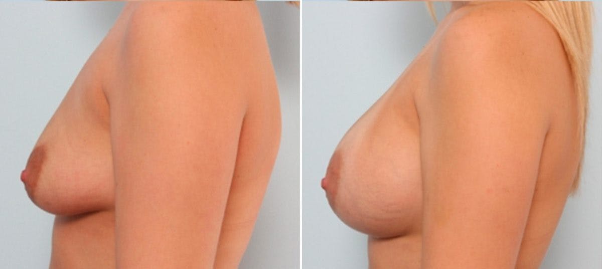 Breast Augmentation Before & After Gallery - Patient 54883907 - Image 5