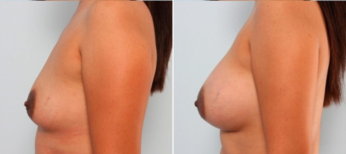 Breast Augmentation Before & After Gallery - Patient 54883908 - Image 5