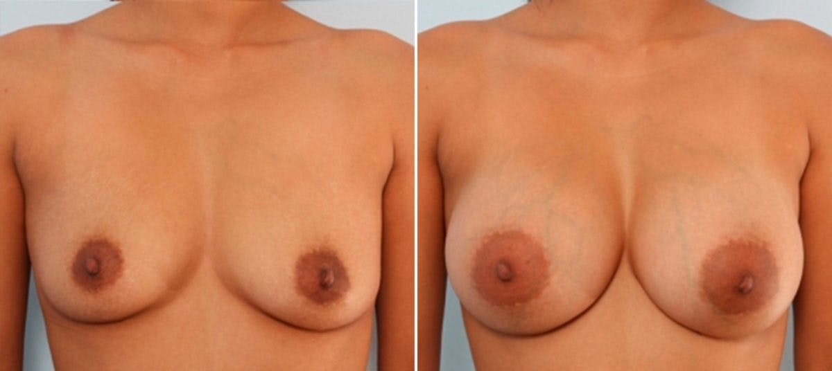 Breast Augmentation Before & After Gallery - Patient 54883911 - Image 1