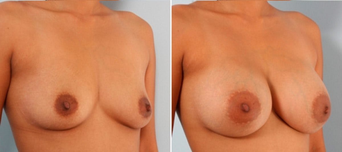 Breast Augmentation Before & After Gallery - Patient 54883911 - Image 2