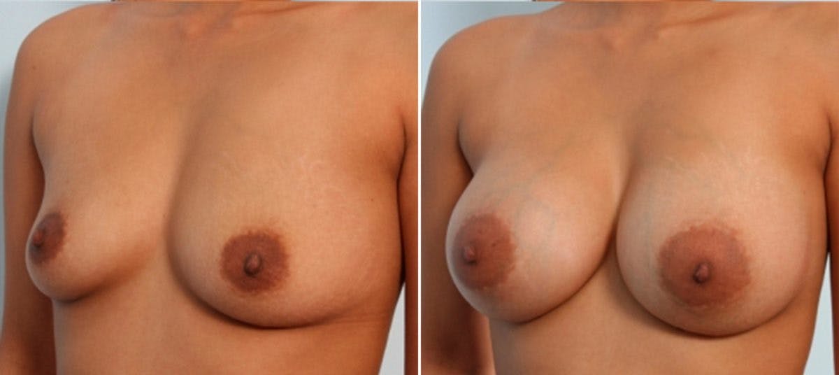 Breast Augmentation Before & After Gallery - Patient 54883911 - Image 4