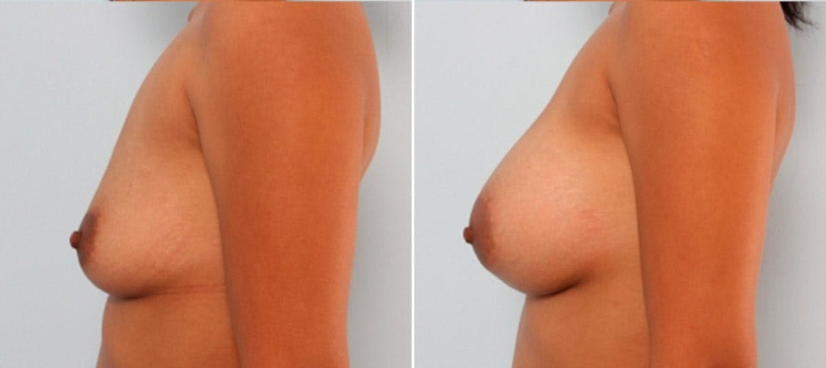 Breast Augmentation Before & After Gallery - Patient 54883911 - Image 5