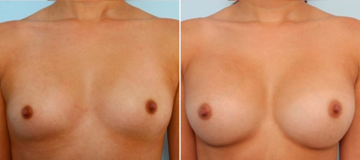 Breast Augmentation Before & After Gallery - Patient 54883913 - Image 1