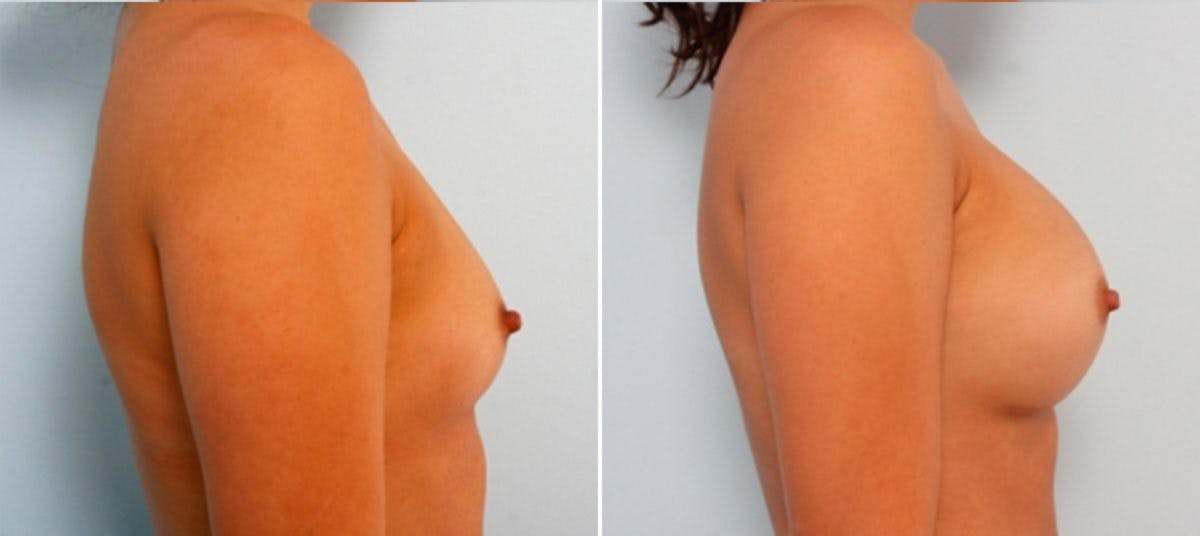 Breast Augmentation Before & After Gallery - Patient 54883913 - Image 3