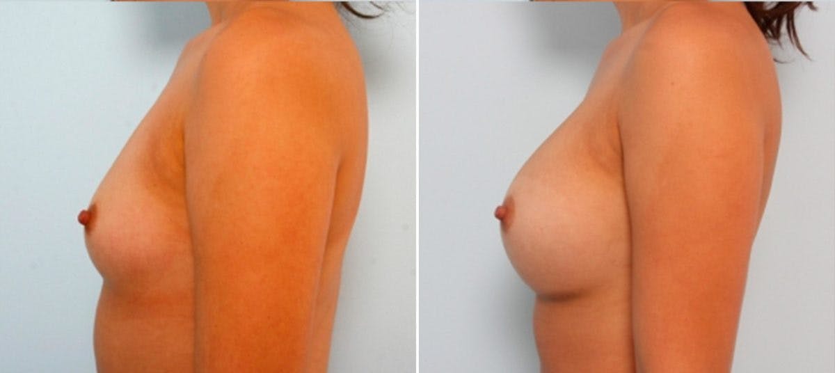 Breast Augmentation Before & After Gallery - Patient 54883913 - Image 5