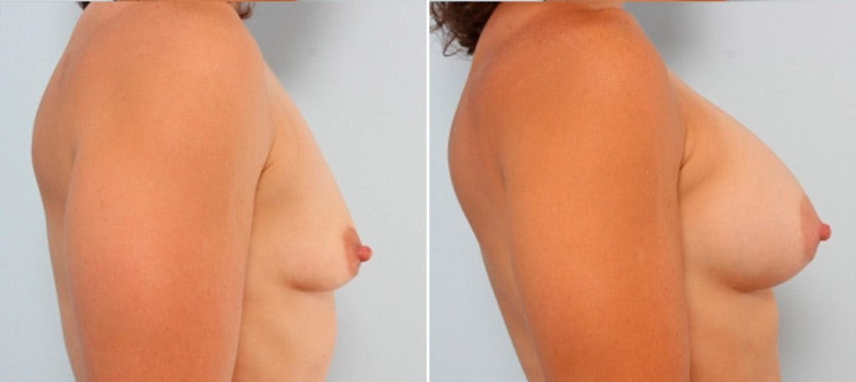 Breast Augmentation Before & After Gallery - Patient 54883916 - Image 3