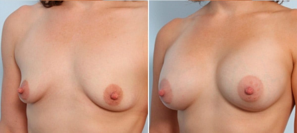 Breast Augmentation Before & After Gallery - Patient 54883916 - Image 4