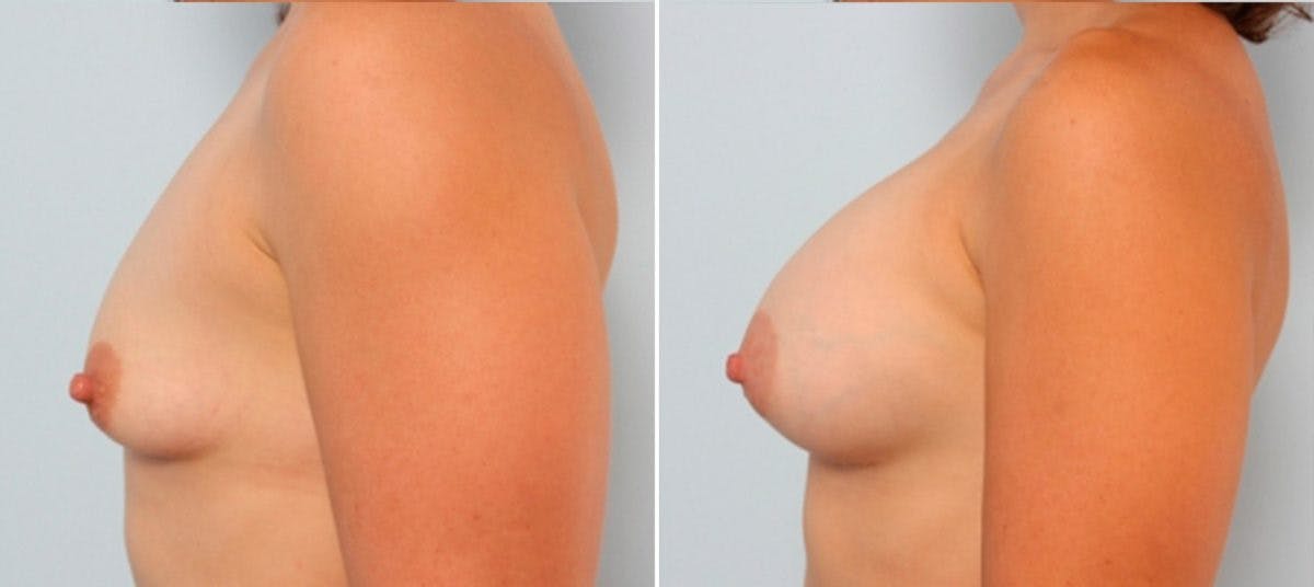 Breast Augmentation Before & After Gallery - Patient 54883916 - Image 5