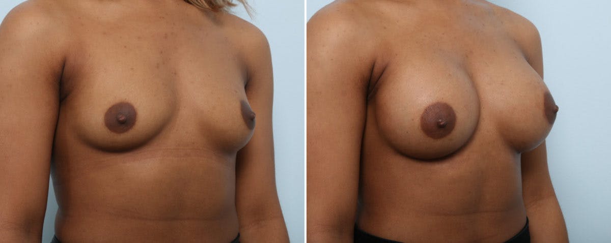 Breast Augmentation Before & After Gallery - Patient 54883918 - Image 2