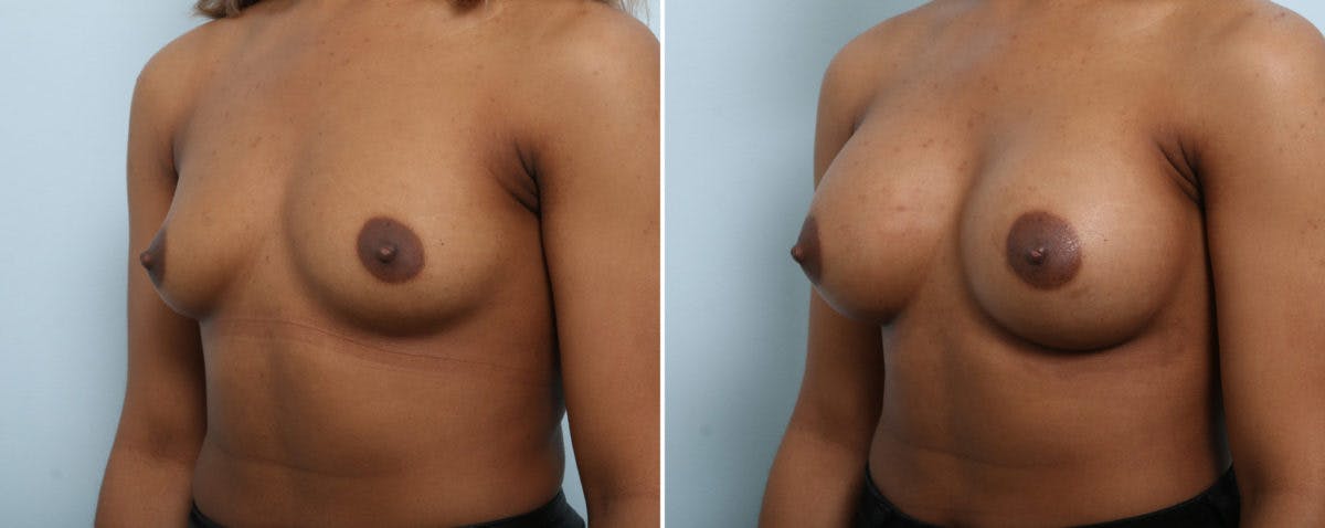 Breast Augmentation Before & After Gallery - Patient 54883918 - Image 4