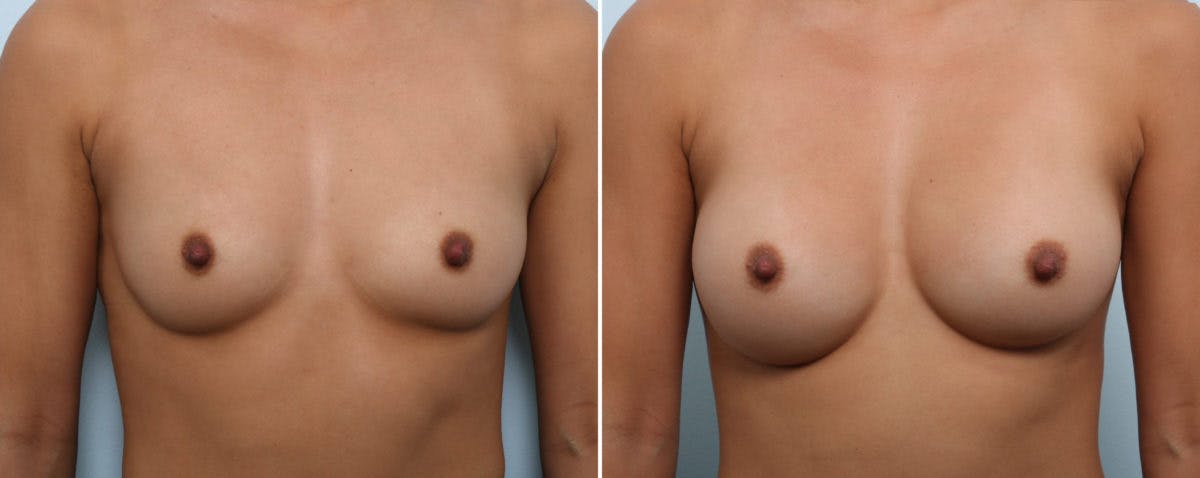 Breast Augmentation Before & After Photo - Patient 54883928 - Image 1