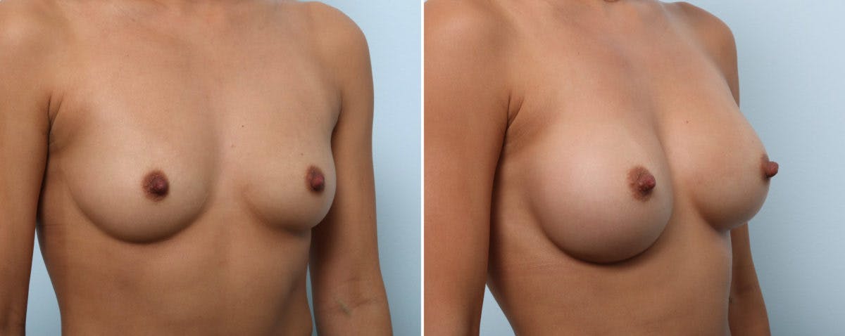 Breast Augmentation Before & After Photo - Patient 54883928 - Image 2