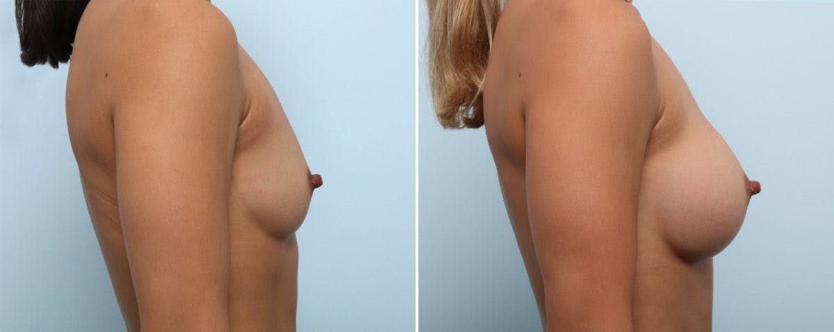 Breast Augmentation Before & After Gallery - Patient 54883928 - Image 3