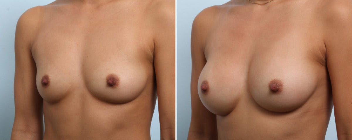 Breast Augmentation Before & After Gallery - Patient 54883928 - Image 4