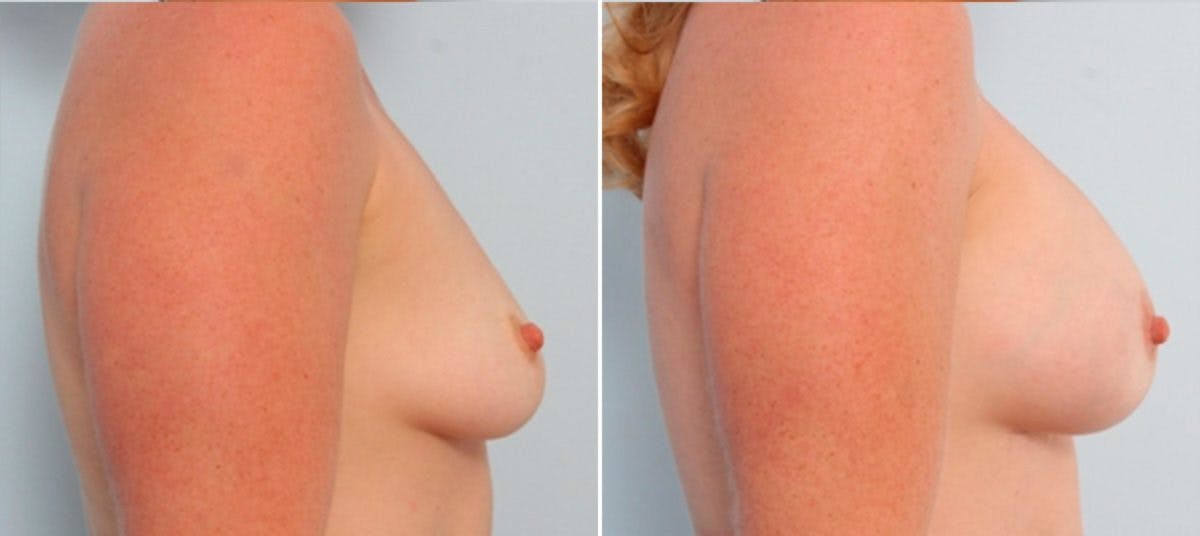 Breast Augmentation Before & After Gallery - Patient 54883929 - Image 3