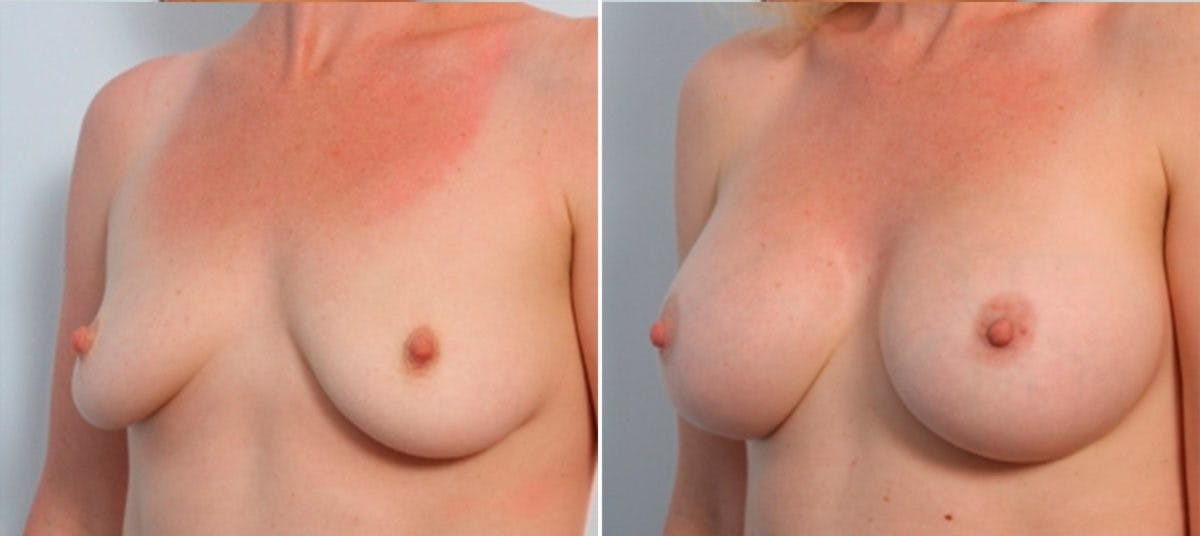 Breast Augmentation Before & After Gallery - Patient 54883929 - Image 4