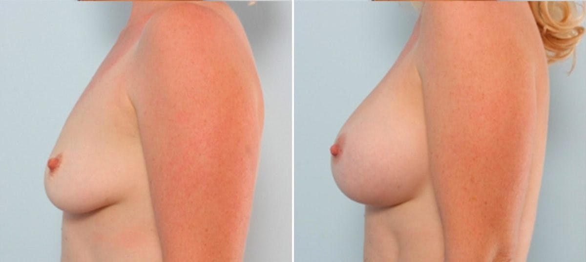 Breast Augmentation Before & After Gallery - Patient 54883929 - Image 5