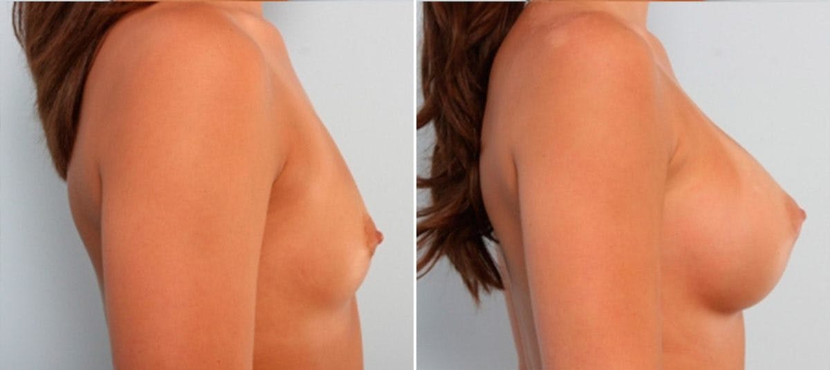 Breast Augmentation Before & After Gallery - Patient 54883930 - Image 3