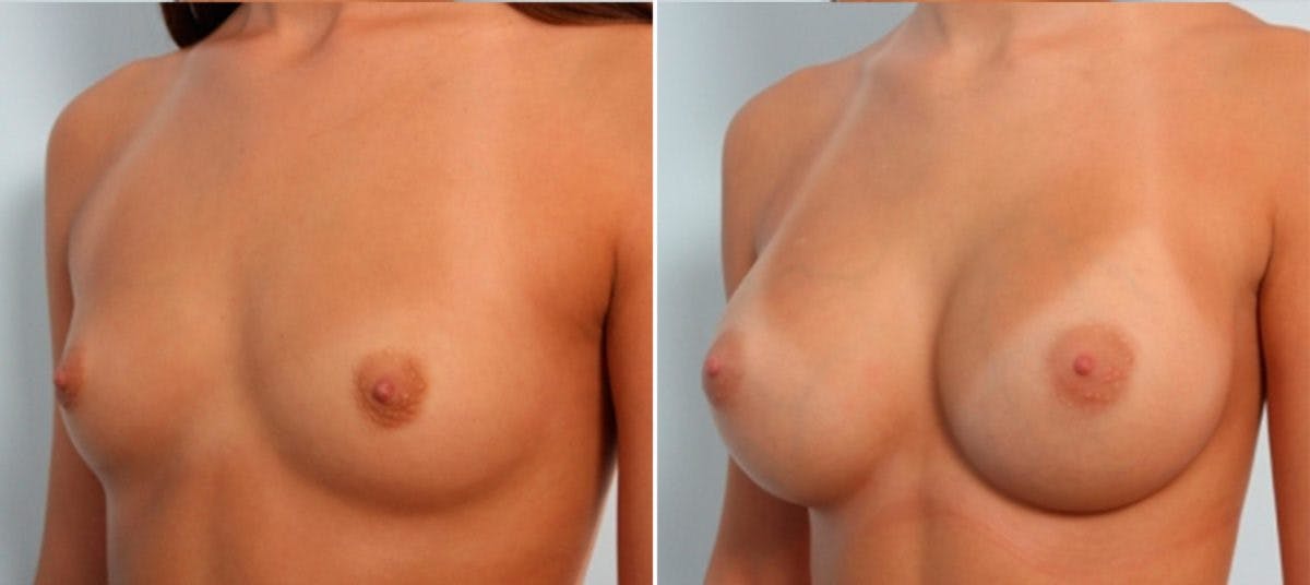 Breast Augmentation Before & After Gallery - Patient 54883930 - Image 4