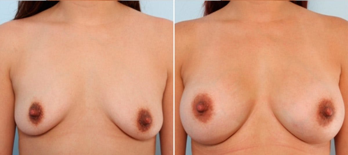 Breast Augmentation Before & After Gallery - Patient 54883938 - Image 1