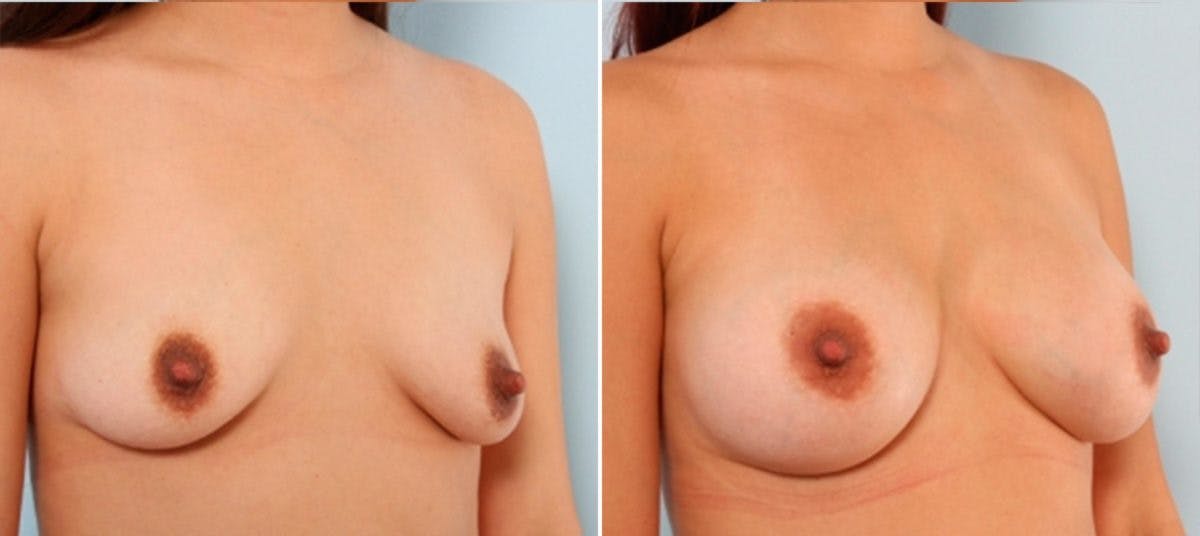 Breast Augmentation Before & After Gallery - Patient 54883938 - Image 2