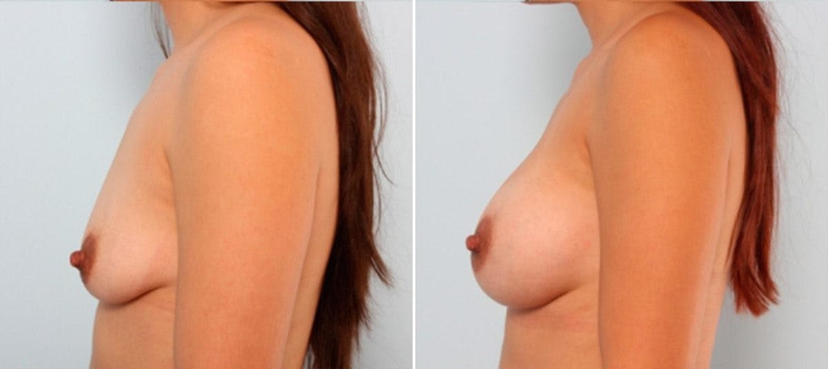 Breast Augmentation Before & After Gallery - Patient 54883938 - Image 5