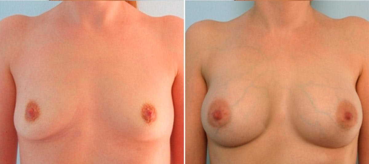 Breast Augmentation Before & After Gallery - Patient 54883939 - Image 1