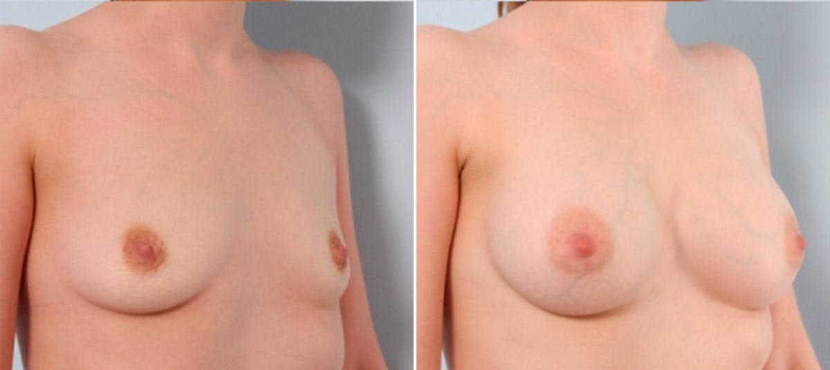 Breast Augmentation Before & After Gallery - Patient 54883939 - Image 2