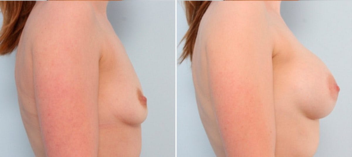 Breast Augmentation Before & After Gallery - Patient 54883939 - Image 3