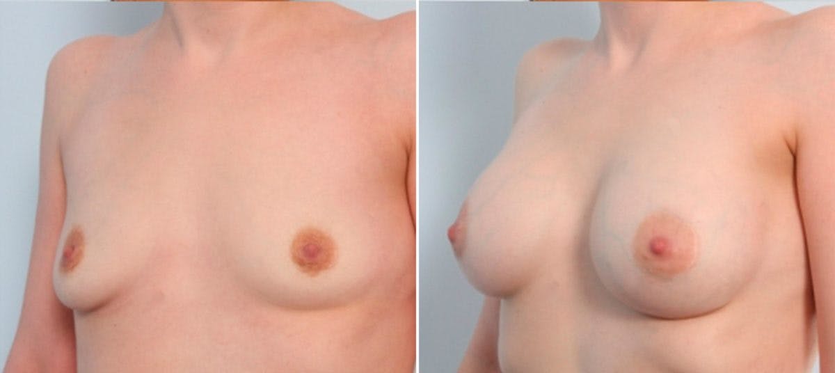 Breast Augmentation Before & After Gallery - Patient 54883939 - Image 4