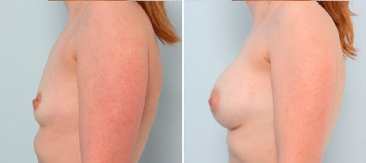 Breast Augmentation Before & After Gallery - Patient 54883939 - Image 5