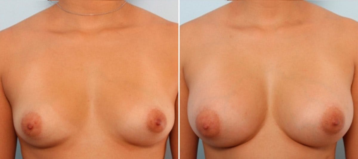 Breast Augmentation Before & After Gallery - Patient 54883941 - Image 1