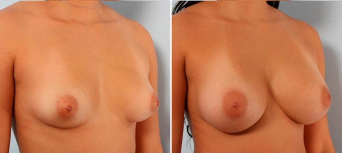 Breast Augmentation Before & After Gallery - Patient 54883941 - Image 2