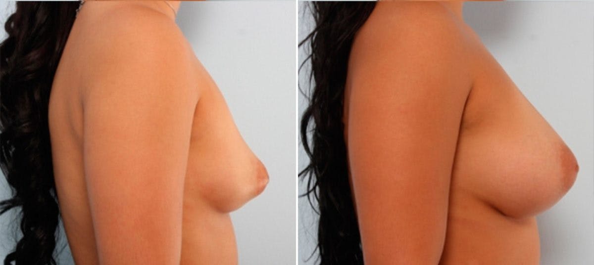 Breast Augmentation Before & After Gallery - Patient 54883941 - Image 3