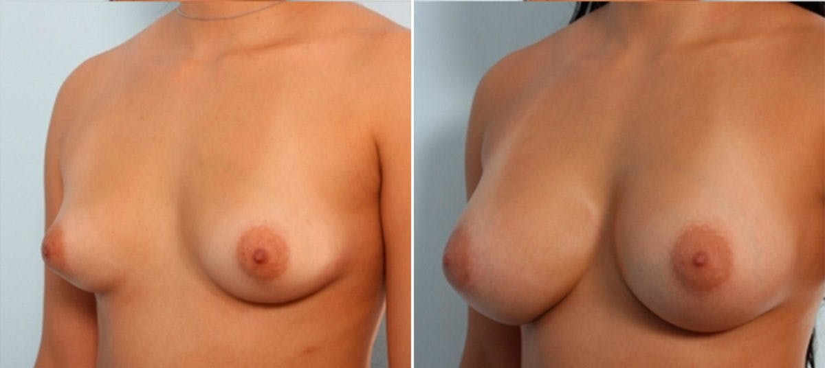 Breast Augmentation Before & After Gallery - Patient 54883941 - Image 4