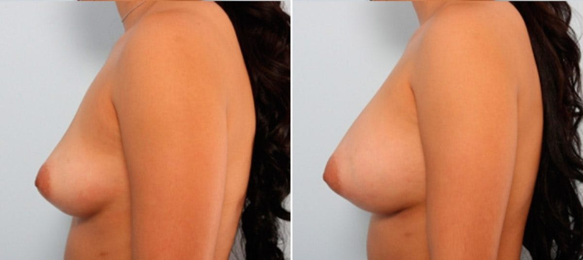 Breast Augmentation Before & After Gallery - Patient 54883941 - Image 5