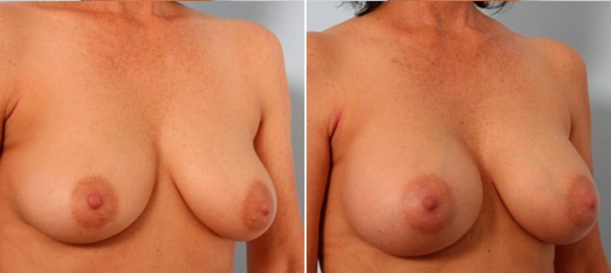 Breast Augmentation Before & After Gallery - Patient 54883943 - Image 2