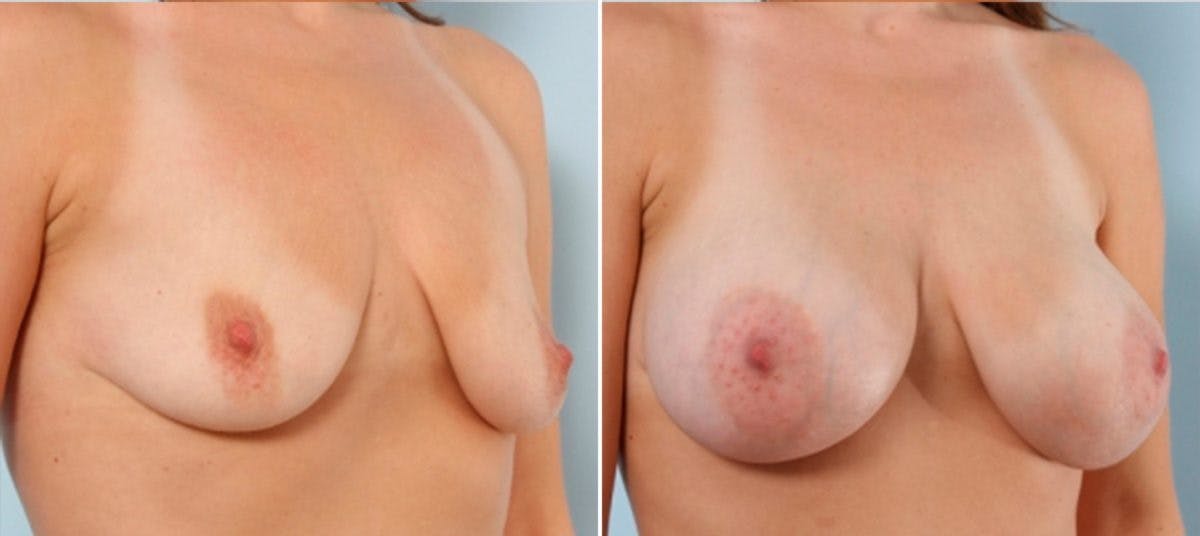 Breast Augmentation Before & After Photo - Patient 54883953 - Image 2