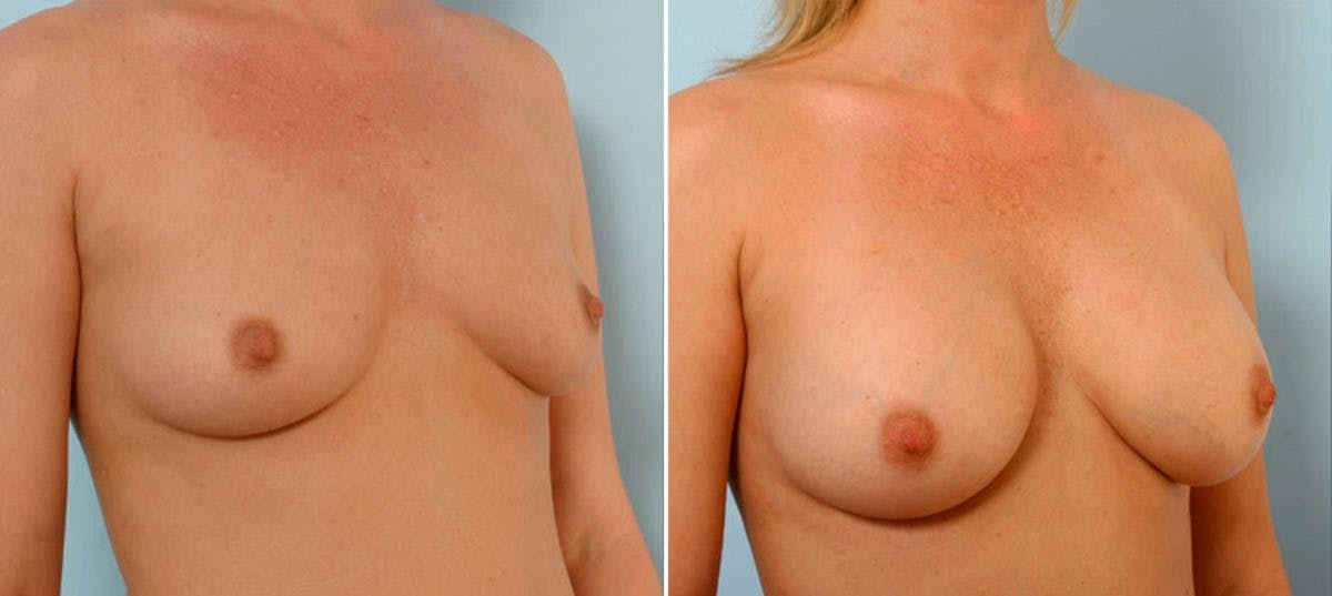 Breast Augmentation Before & After Gallery - Patient 54883954 - Image 2