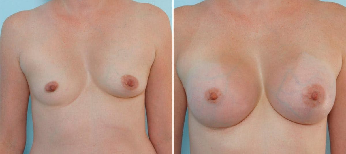 Breast Augmentation Before & After Photo - Patient 54883956 - Image 1