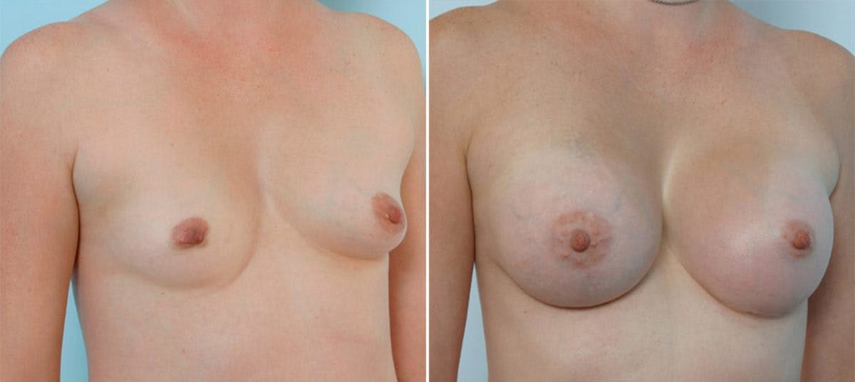 Breast Augmentation Before & After Photo - Patient 54883956 - Image 2