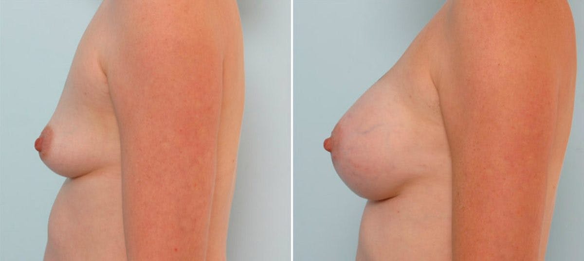 Breast Augmentation Before & After Gallery - Patient 54883956 - Image 4