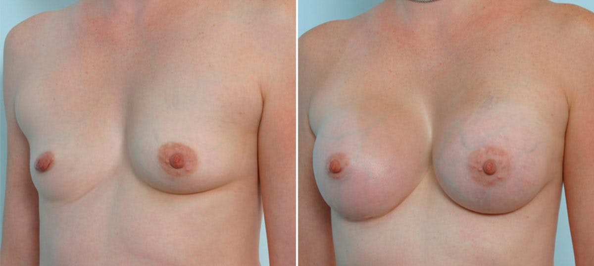 Breast Augmentation Before & After Photo - Patient 54883956 - Image 5