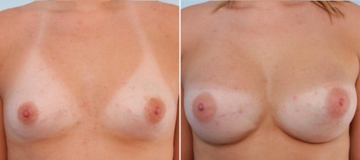 Breast Augmentation Before & After Photo - Patient 54883957 - Image 1