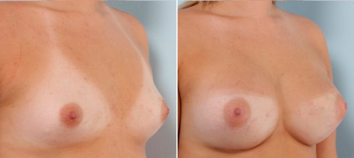 Breast Augmentation Before & After Photo - Patient 54883957 - Image 2