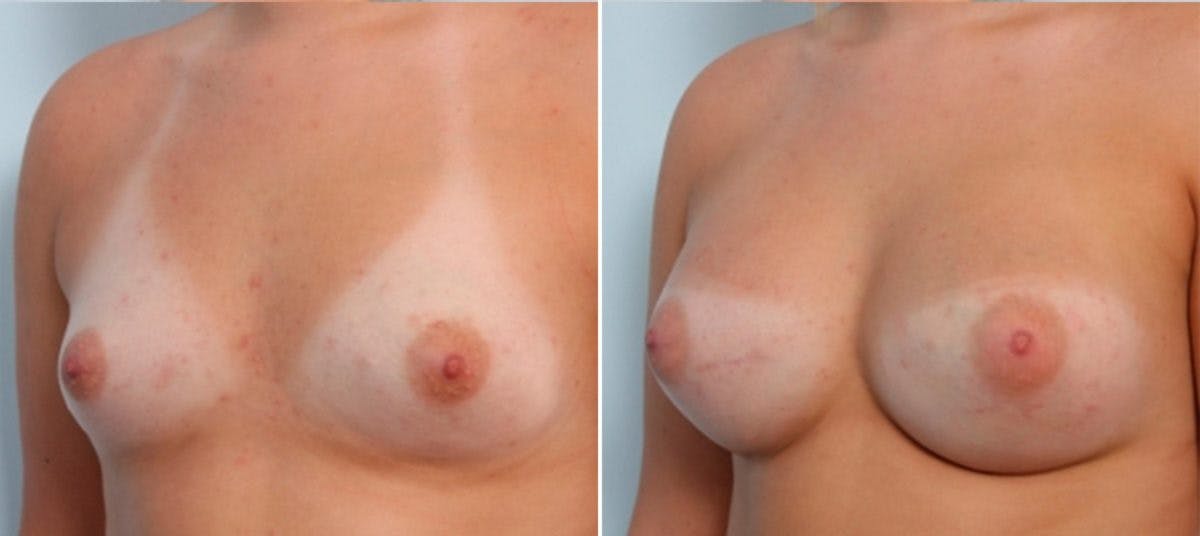 Breast Augmentation Before & After Gallery - Patient 54883957 - Image 4