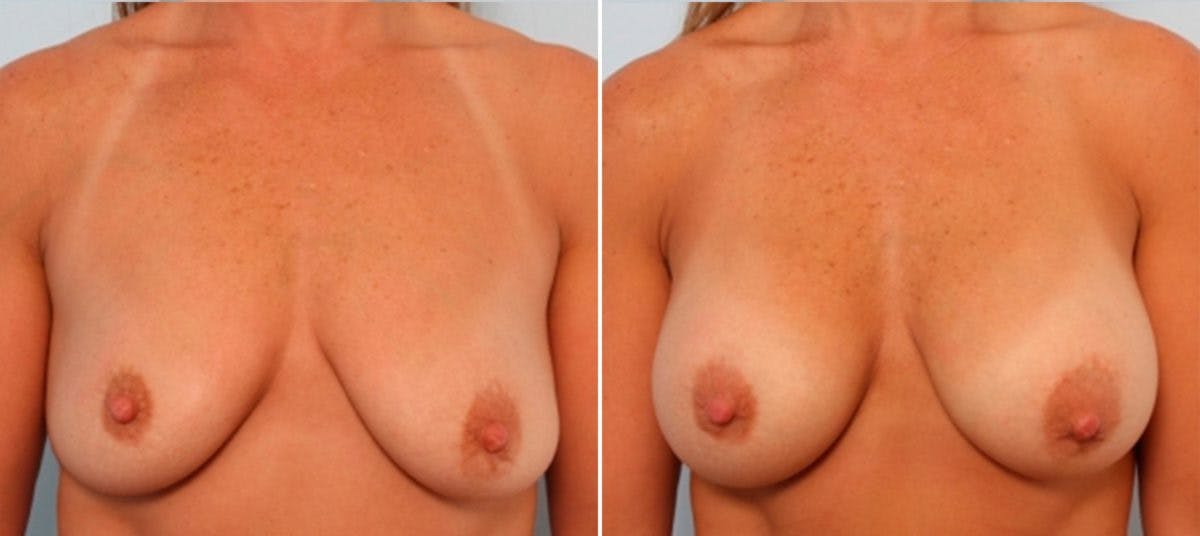 Breast Augmentation Before & After Gallery - Patient 54883999 - Image 1