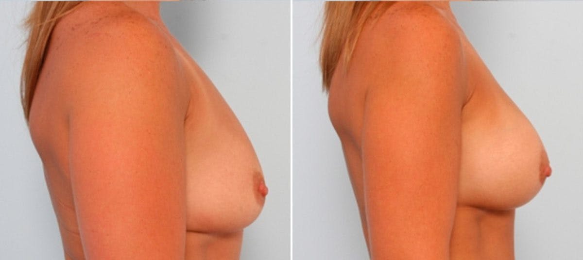 Breast Augmentation Before & After Gallery - Patient 54883999 - Image 3