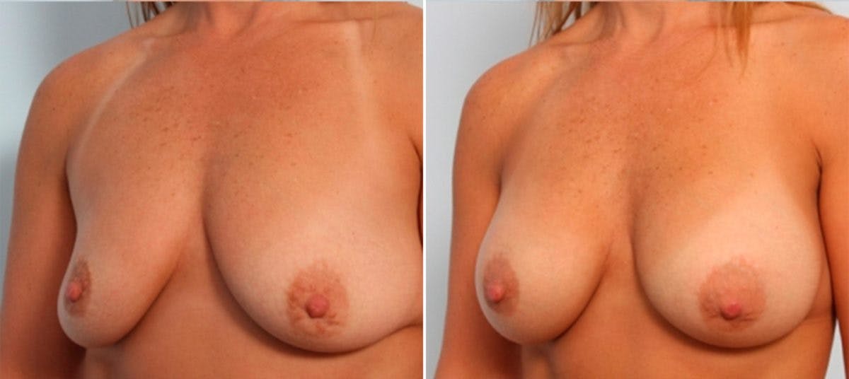 Breast Augmentation Before & After Gallery - Patient 54883999 - Image 4